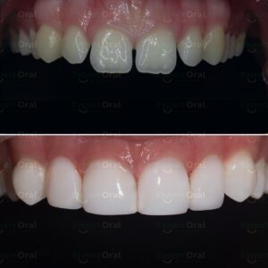 Hollywood smile makeover with composite veneers