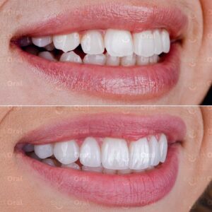 hollywood smile makeover with porcelain veneers